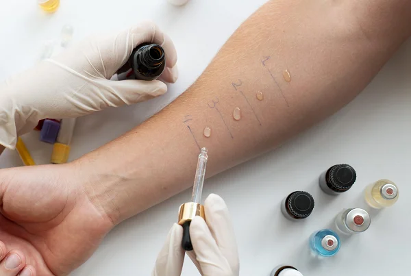 Allergy Testing