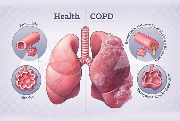 COPD