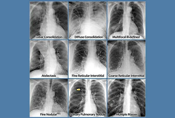 Chest Radiology